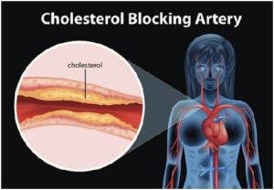 Study finds that cholesterol control must begin before 45 years of age